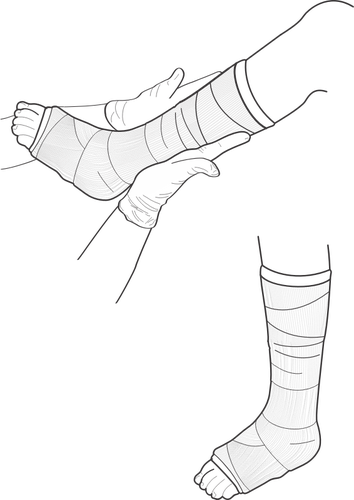 Vektor illustration av benet kasta undersökning